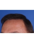 After Hair Transplant&nbsp;Front